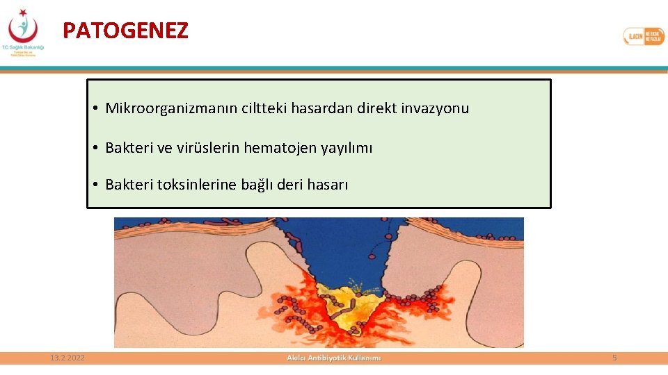 PATOGENEZ • Mikroorganizmanın ciltteki hasardan direkt invazyonu • Bakteri ve virüslerin hematojen yayılımı •