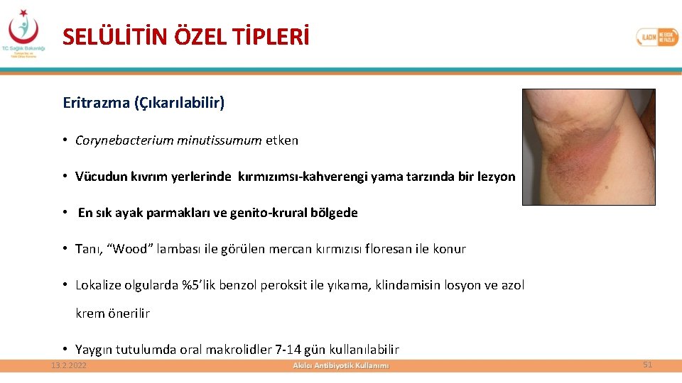 SELÜLİTİN ÖZEL TİPLERİ Eritrazma (Çıkarılabilir) • Corynebacterium minutissumum etken • Vücudun kıvrım yerlerinde kırmızımsı-kahverengi