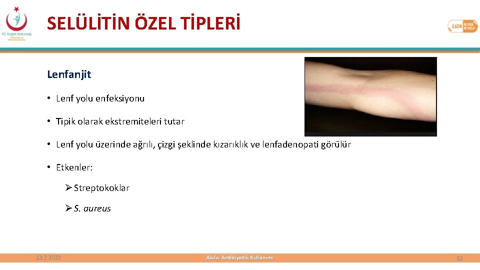 SELÜLİTİN ÖZEL TİPLERİ Lenfanjit • Lenf yolu enfeksiyonu • Tipik olarak ekstremiteleri tutar •