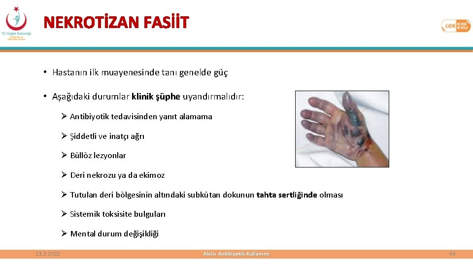 NEKROTİZAN FASİİT • Hastanın ilk muayenesinde tanı genelde güç • Aşağıdaki durumlar klinik şüphe
