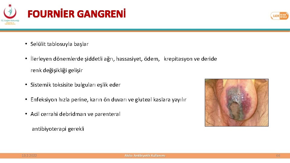 FOURNİER GANGRENİ • Selülit tablosuyla başlar • İlerleyen dönemlerde şiddetli ağrı, hassasiyet, ödem, krepitasyon