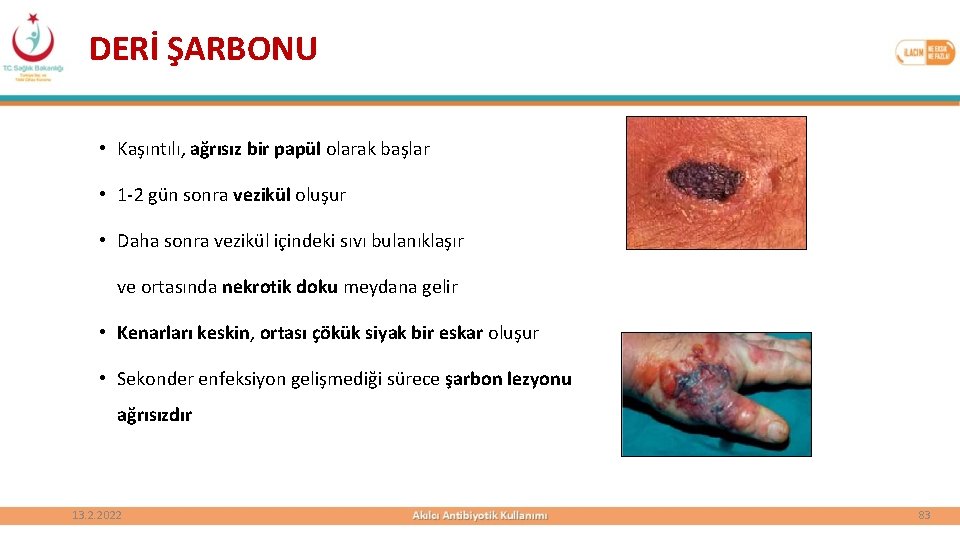 DERİ ŞARBONU • Kaşıntılı, ağrısız bir papül olarak başlar • 1 -2 gün sonra