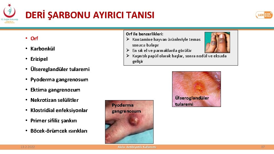 DERİ ŞARBONU AYIRICI TANISI • Orf • Karbonkül • Erizipel Orf ile benzerlikleri: Ø