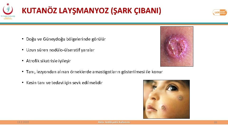 KUTANÖZ LAYŞMANYOZ (ŞARK ÇIBANI) • Doğu ve Güneydoğu bölgelerinde görülür • Uzun süren nodülo-ülseratif