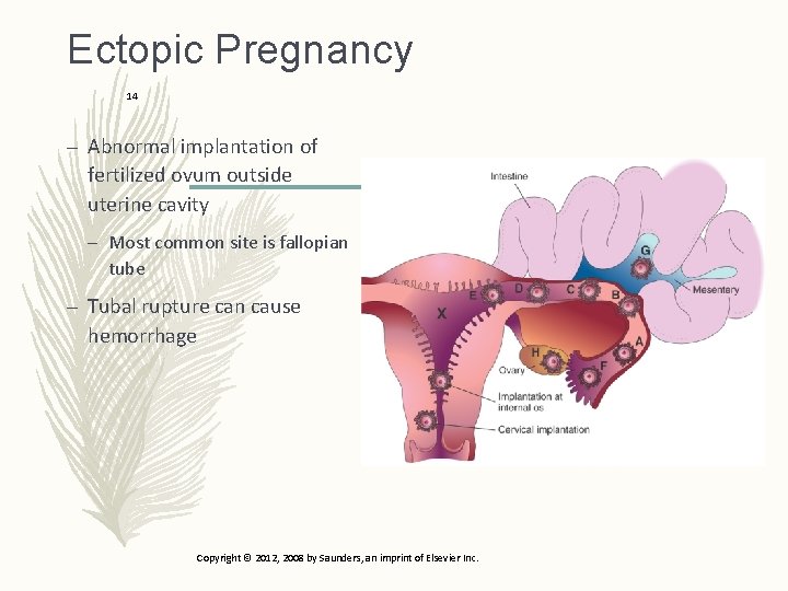 Ectopic Pregnancy 14 – Abnormal implantation of fertilized ovum outside uterine cavity – Most