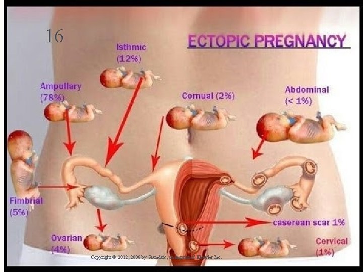 16 Copyright © 2012, 2008 by Saunders, an imprint of Elsevier Inc. 