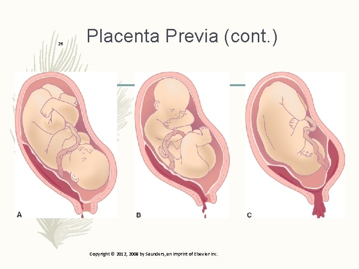 26 Placenta Previa (cont. ) Copyright © 2012, 2008 by Saunders, an imprint of