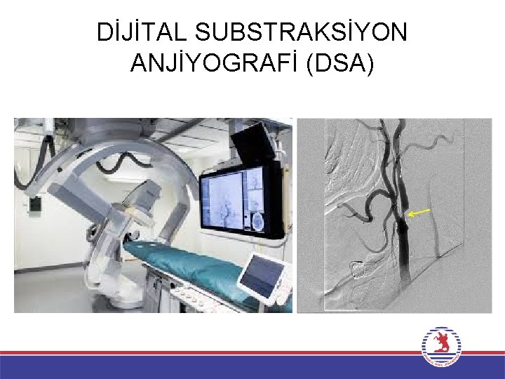 DİJİTAL SUBSTRAKSİYON ANJİYOGRAFİ (DSA) 