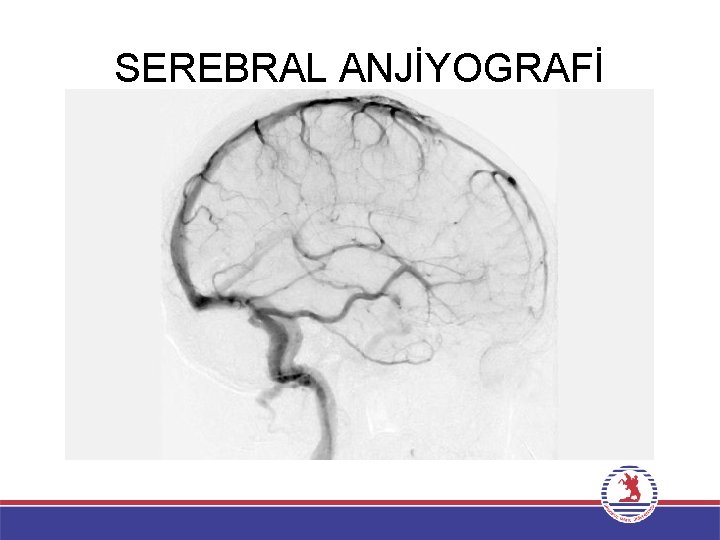 SEREBRAL ANJİYOGRAFİ 