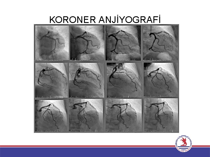 KORONER ANJİYOGRAFİ 