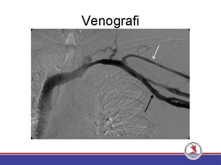 Venografi 