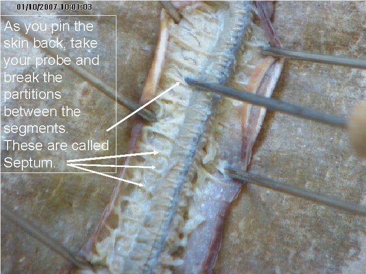 As you pin the skin back, take your probe and break the partitions between As you pin the skin back, take your probe and break the partitions between
