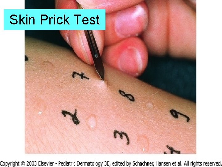Skin Prick Test 58 