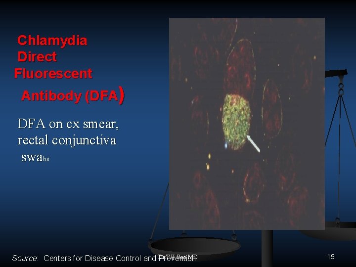 Chlamydia Direct Fluorescent Antibody (DFA) DFA on cx smear, rectal conjunctiva swabs MD Source: