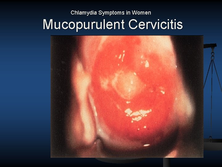 Chlamydia Symptoms in Women Mucopurulent Cervicitis 