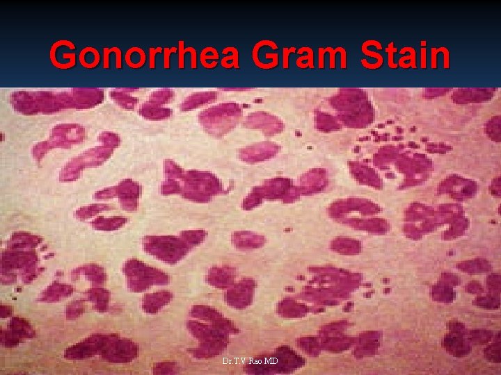 Gonorrhea Gram Stain Dr. T. V. Rao MD Source: Cincinnati STD/HIV Prevention Training Center