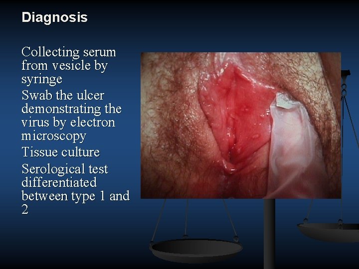 Diagnosis Collecting serum from vesicle by syringe Swab the ulcer demonstrating the virus by