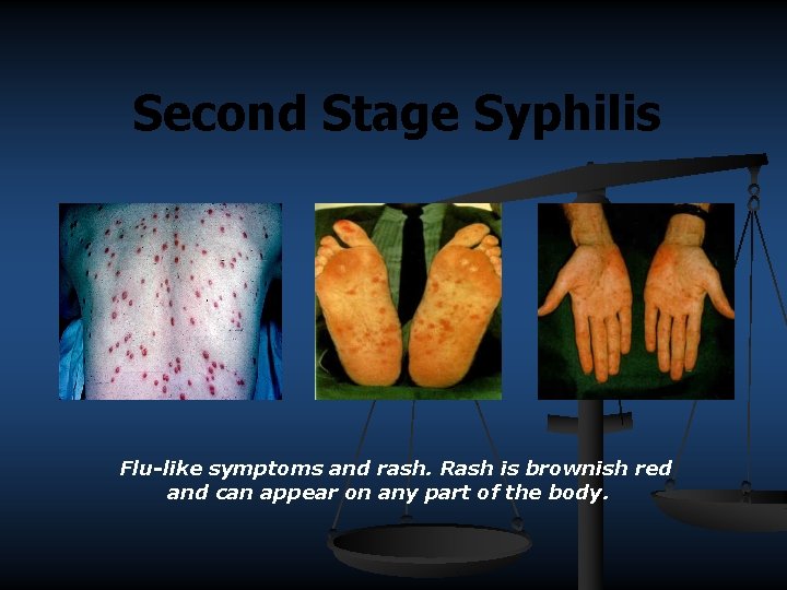 Second Stage Syphilis Flu-like symptoms and rash. Rash is brownish red and can appear