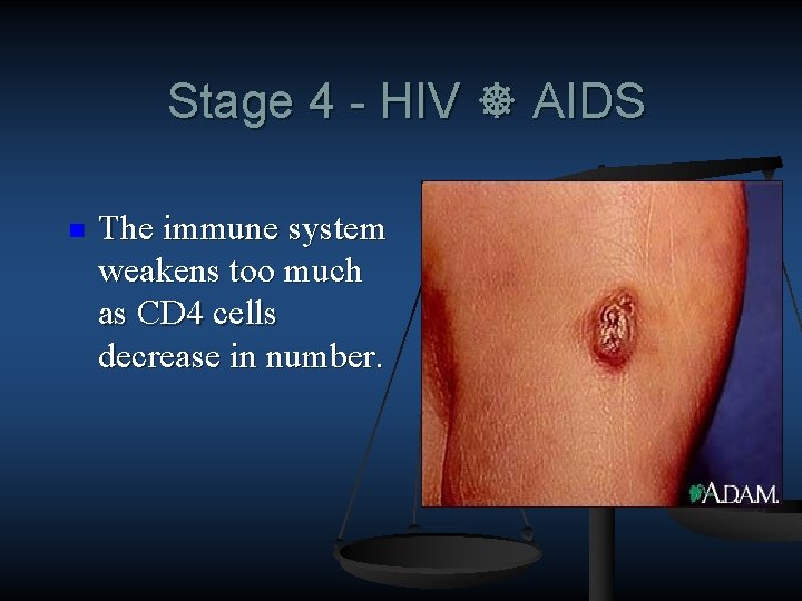 Stage 4 - HIV AIDS n The immune system weakens too much as CD