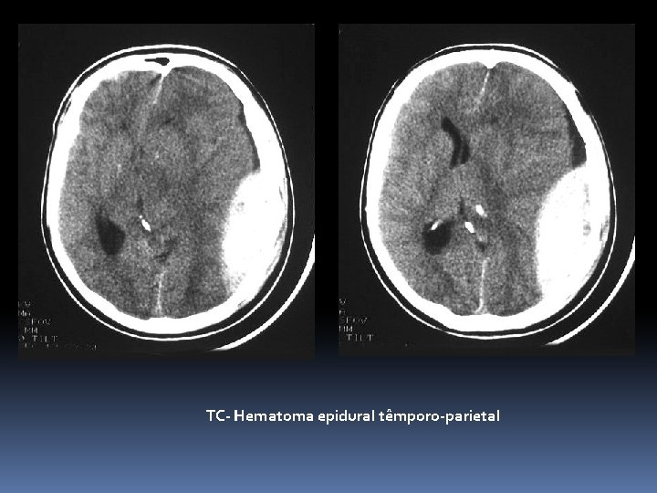 TC- Hematoma epidural têmporo-parietal 