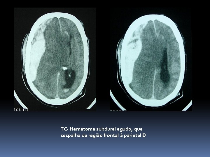 TC- Hematoma subdural agudo, que sespalha da região frontal à parietal D 