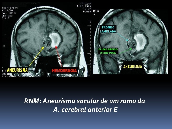 RNM: Aneurisma sacular de um ramo da A. cerebral anterior E 
