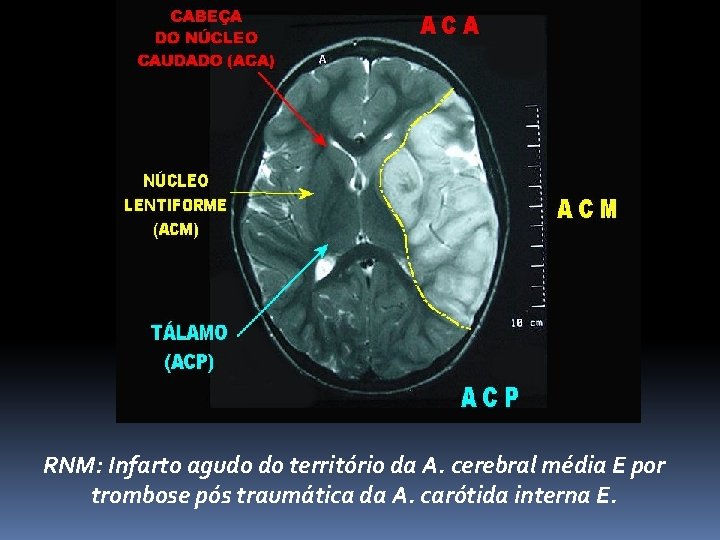 RNM: Infarto agudo do território da A. cerebral média E por trombose pós traumática