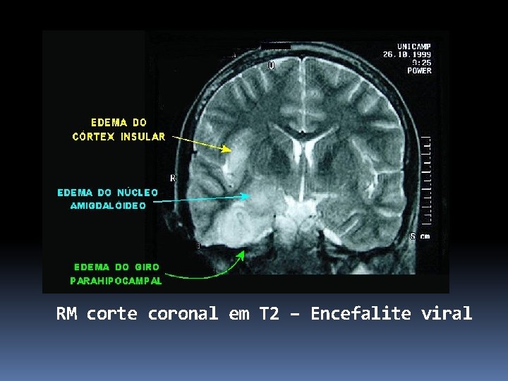 RM corte coronal em T 2 – Encefalite viral 