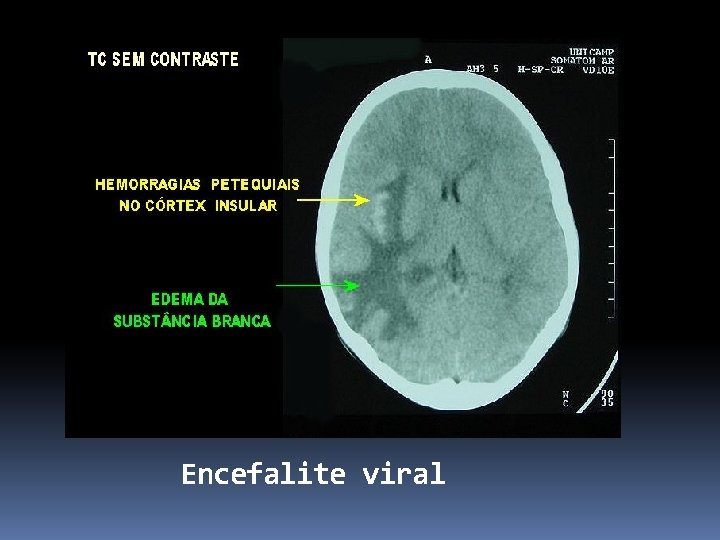 Encefalite viral 