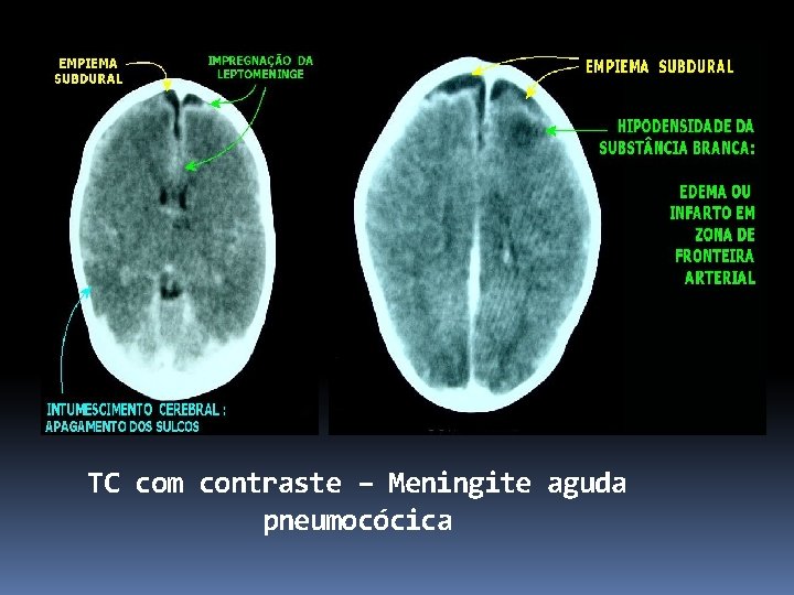 TC com contraste – Meningite aguda pneumocócica 