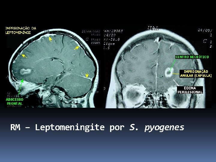 RM – Leptomeningite por S. pyogenes 