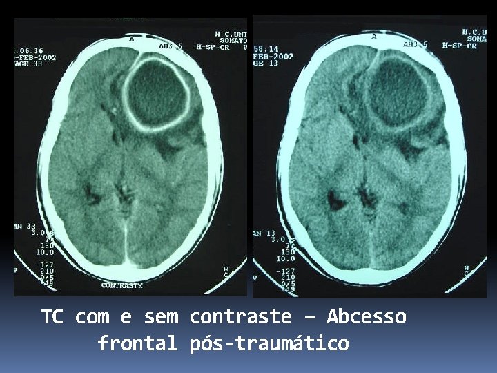 TC com e sem contraste – Abcesso frontal pós-traumático 