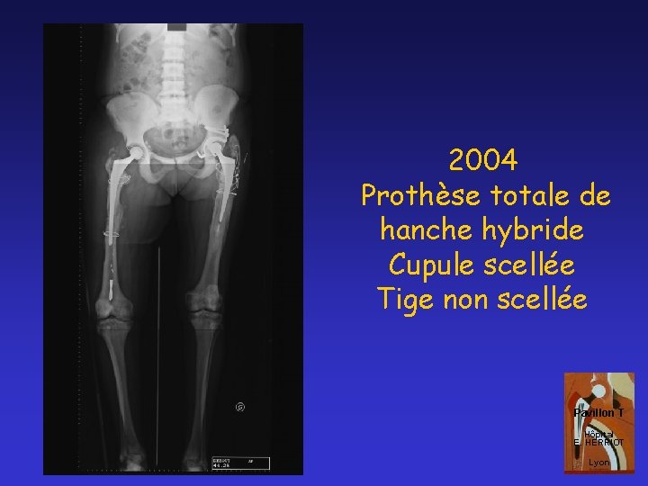 2004 Prothèse totale de hanche hybride Cupule scellée Tige non scellée Pavillon T Hôpital