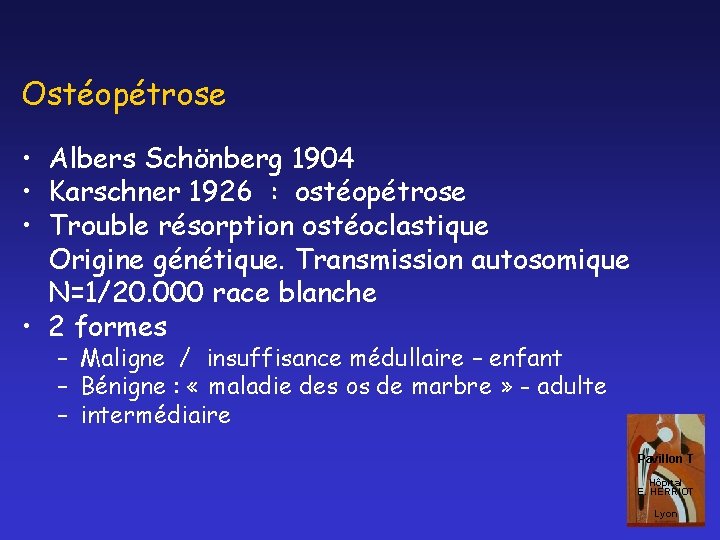 Ostéopétrose • Albers Schönberg 1904 • Karschner 1926 : ostéopétrose • Trouble résorption ostéoclastique