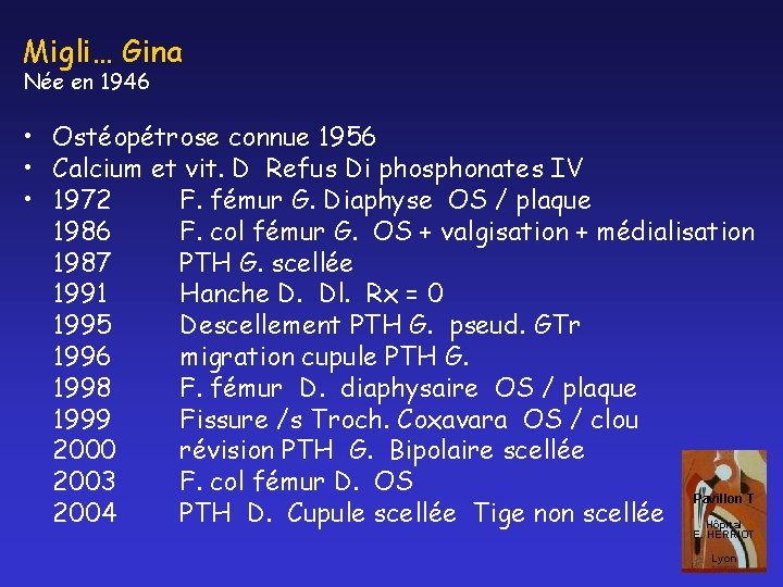 Migli… Gina Née en 1946 • Ostéopétrose connue 1956 • Calcium et vit. D