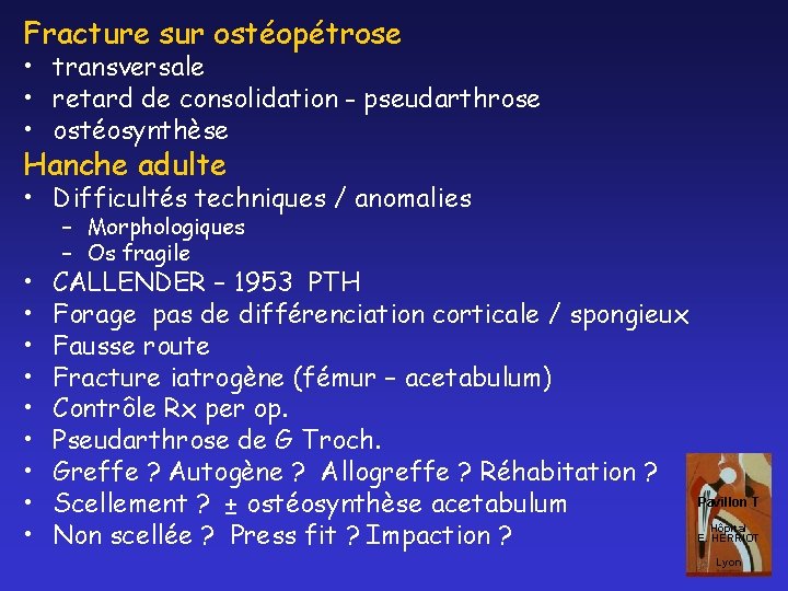 Fracture sur ostéopétrose • transversale • retard de consolidation - pseudarthrose • ostéosynthèse Hanche