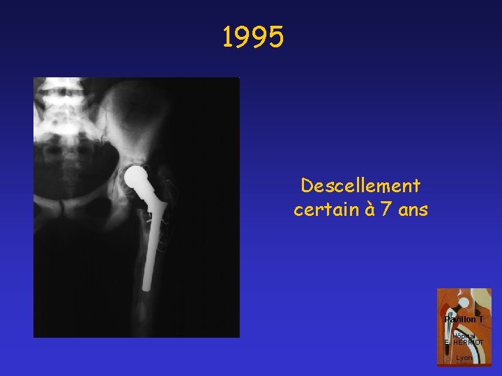 1995 Descellement certain à 7 ans Pavillon T Hôpital E. HERRIOT Lyon 