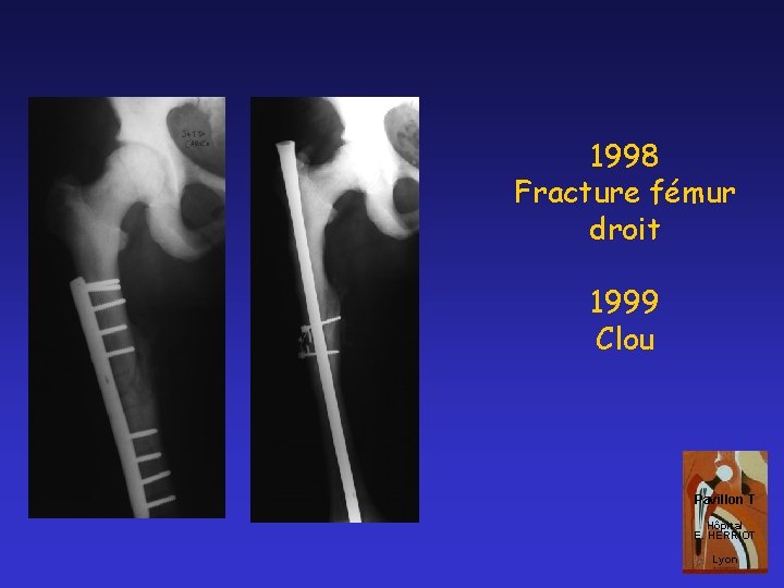 1998 Fracture fémur droit 1999 Clou Pavillon T Hôpital E. HERRIOT Lyon 