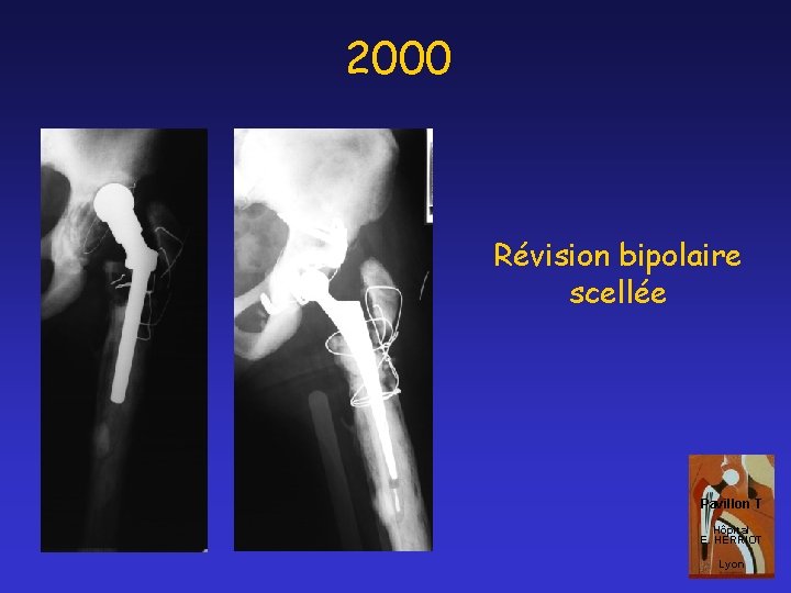 2000 Révision bipolaire scellée Pavillon T Hôpital E. HERRIOT Lyon 