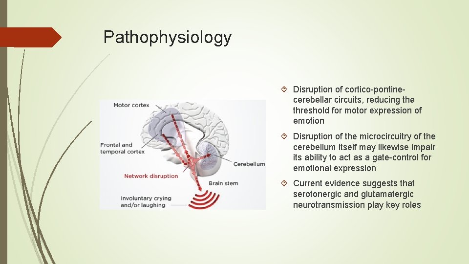 Pathophysiology Disruption of cortico pontine cerebellar circuits, reducing the threshold for motor expression of