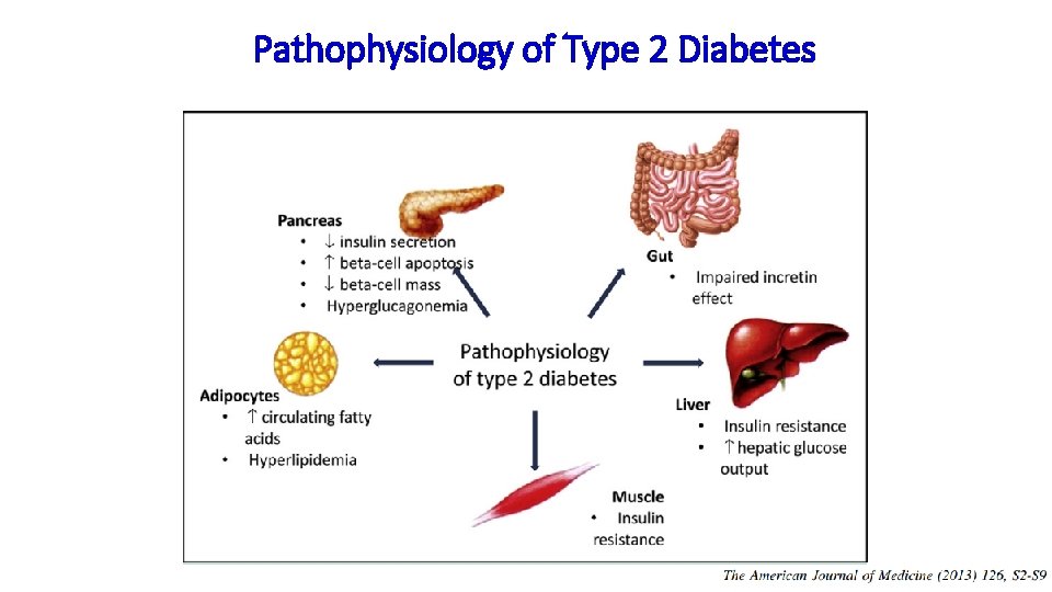Pathophysiology of Type 2 Diabetes 
