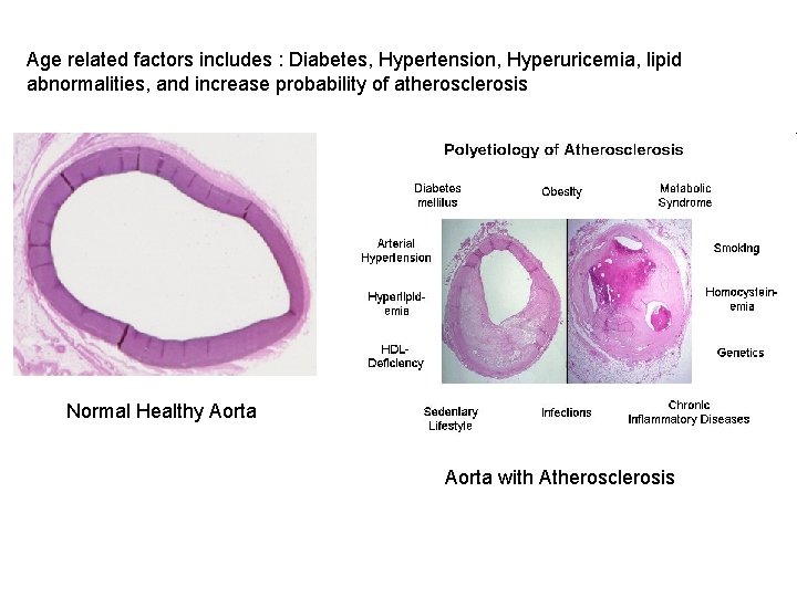 Age related factors includes : Diabetes, Hypertension, Hyperuricemia, lipid abnormalities, and increase probability of