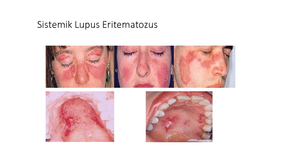 Sistemik Lupus Eritematozus 