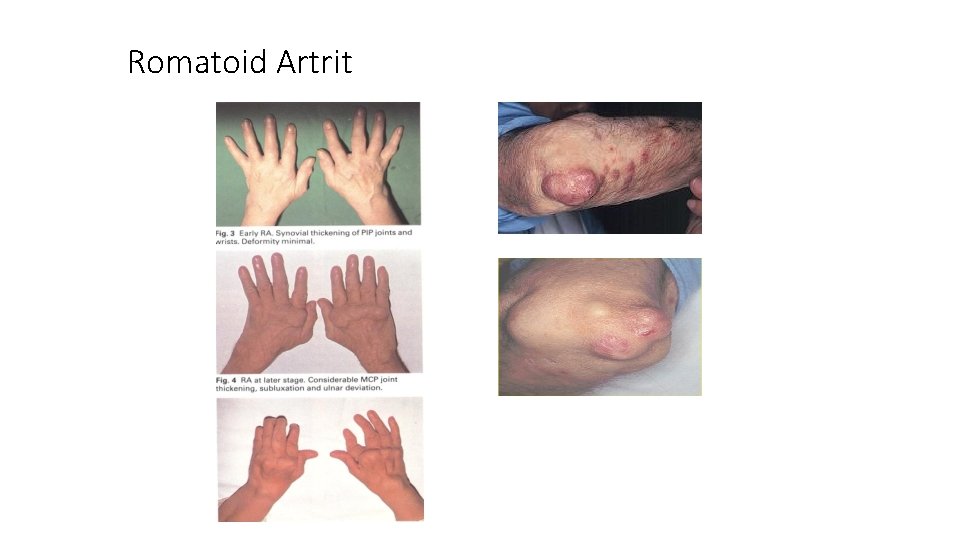 Romatoid Artrit 