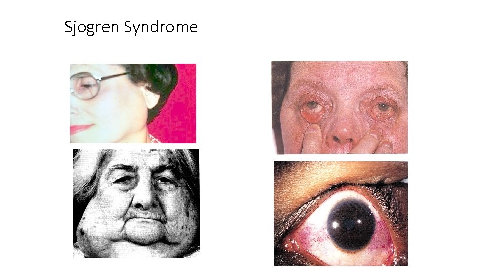 Sjogren Syndrome 