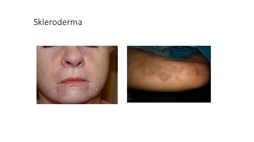 Skleroderma 