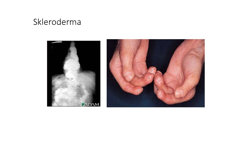 Skleroderma 