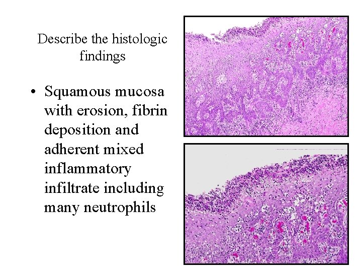 Describe the histologic findings • Squamous mucosa with erosion, fibrin deposition and adherent mixed