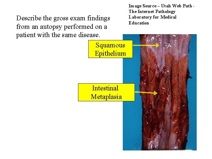 Describe the gross exam findings from an autopsy performed on a patient with the