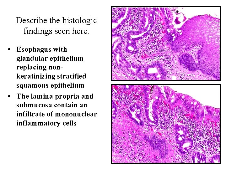 Describe the histologic findings seen here. • Esophagus with glandular epithelium replacing nonkeratinizing stratified